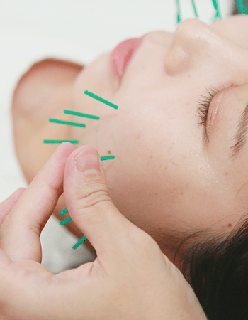 《初回限定/たるみを引き上げ理想のお顔へ♪》美容鍼90分