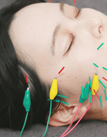 《血流促進・コリの改善に★》鍼施術 40分