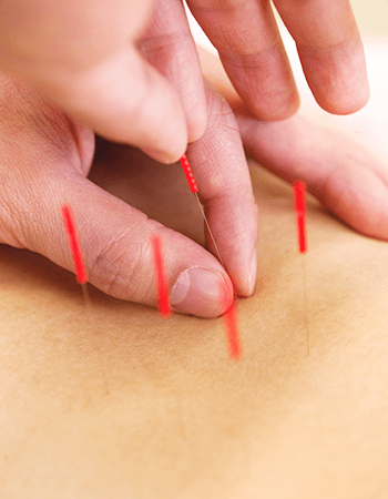 《血流促進・コリの改善に★》鍼施術 40分